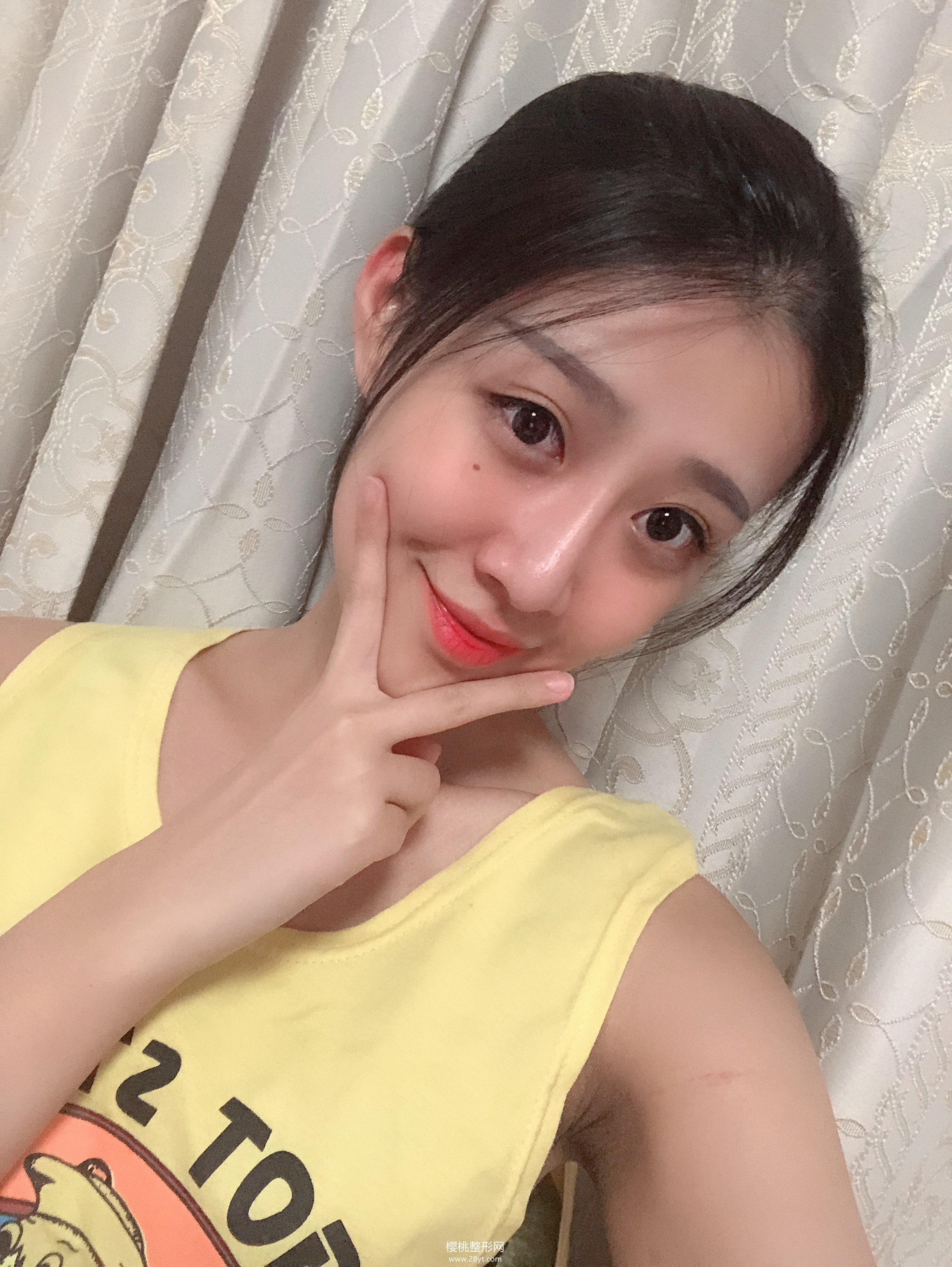 福州海峡李丽强做双眼皮技术怎么样?附真人案例+最新价格表一览