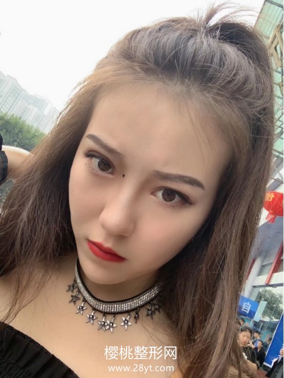 周鹏起做眼睛怎么样?术后二个月效果分享+医生信息介绍