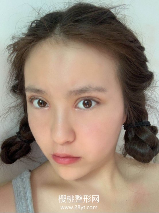 周鹏起做眼睛怎么样?术后二个月效果分享+医生信息介绍