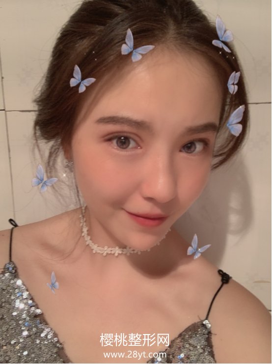 周鹏起做眼睛怎么样?术后二个月效果分享+医生信息介绍