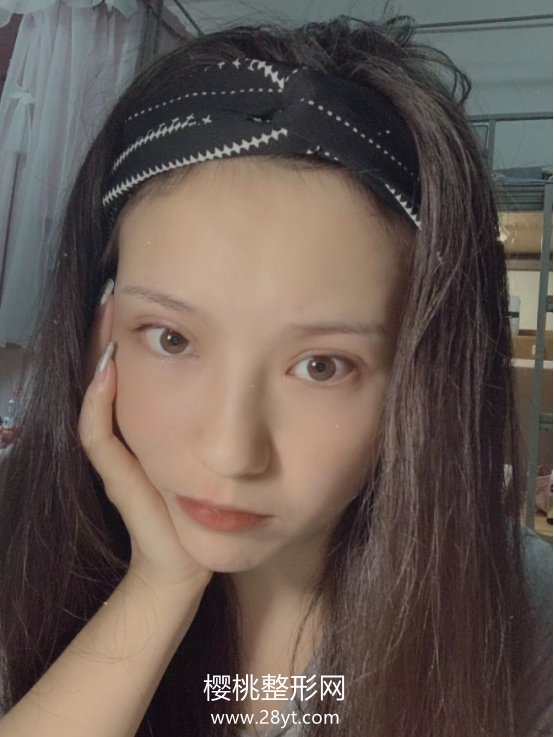 周鹏起做眼睛怎么样?术后二个月效果分享+医生信息介绍