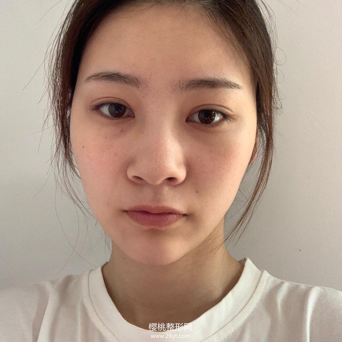 福州爱美尔张胜利隆鼻技术怎么样?附真人案例+最新价格表一览