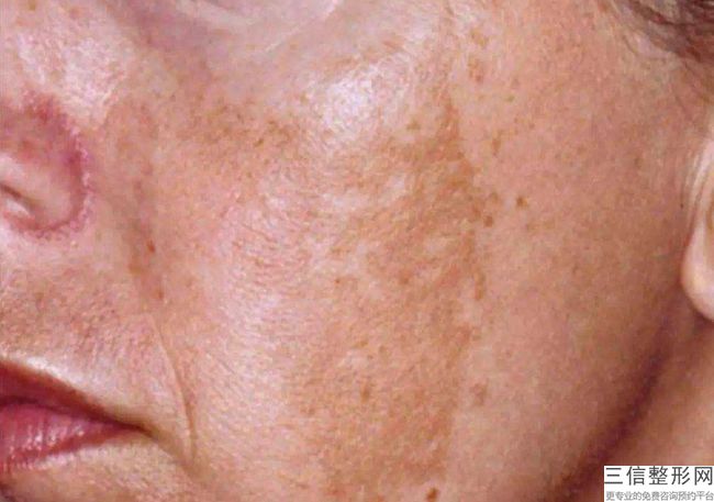 影响腋下脱毛价格的因素有哪些?激光脱毛可以快速祛除