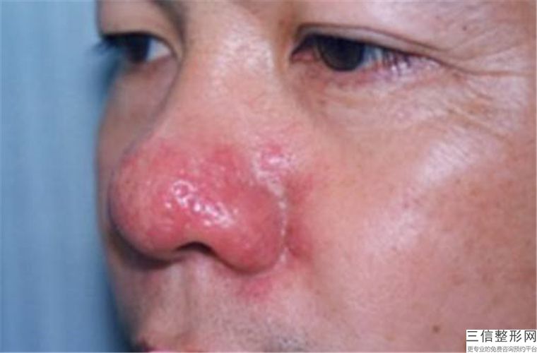 鼻孔矫正手术,鼻孔成形术