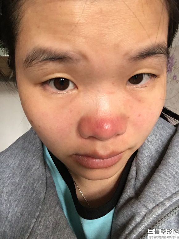 鼻孔矫正手术,鼻孔成形术