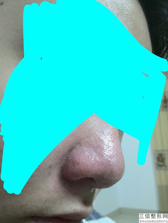 鼻孔矫正手术,鼻孔成形术