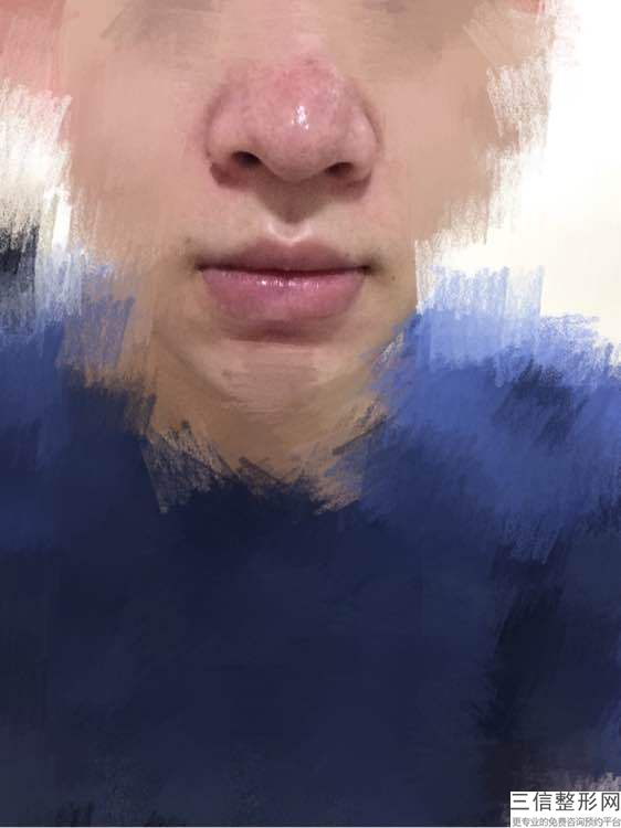 鼻孔里面大小不一样怎么办,鼻孔大小不一样是怎么回事