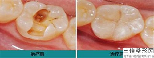 2023年杭州市做矫正牙齿具体费用-杭州市做矫正牙齿均价为:47823元