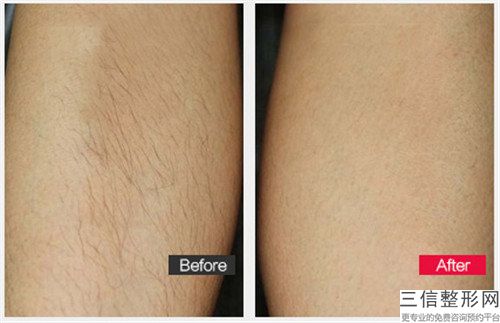 岳阳市激光脱毛光子脱毛人气价格表抢鲜2023(10月-4月均价为:1732元)