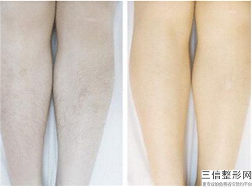 邢台市胳膊脱毛整形科价格表(费用)公布-邢台市胳膊脱毛大概费用多少钱