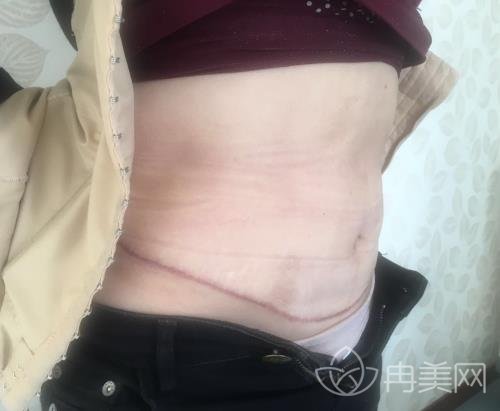 慕名去无锡同济整形做了祛疤,肚子上难看的疤痕不见了