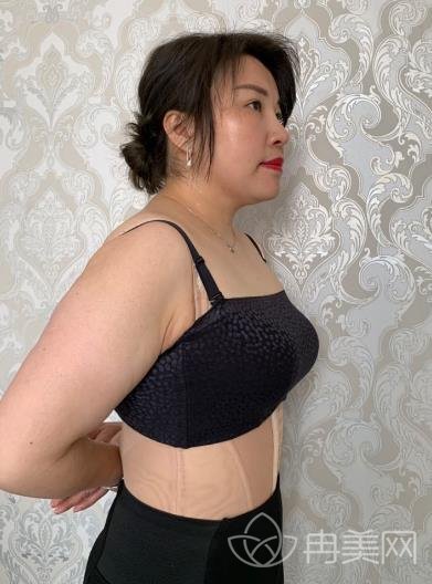 慕名去无锡同济整形做了祛疤,肚子上难看的疤痕不见了