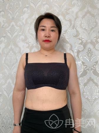 慕名去无锡同济整形做了祛疤,肚子上难看的疤痕不见了