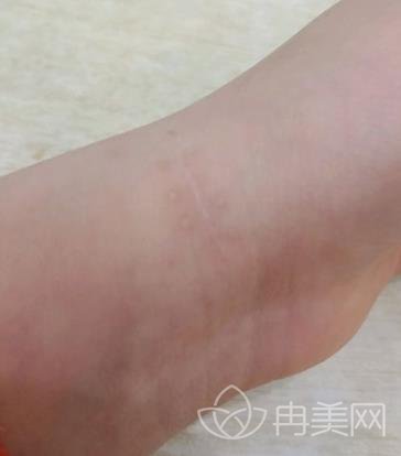 佳木斯大学附属医院整形烧伤科价格表+做祛疤4次治疗效果图