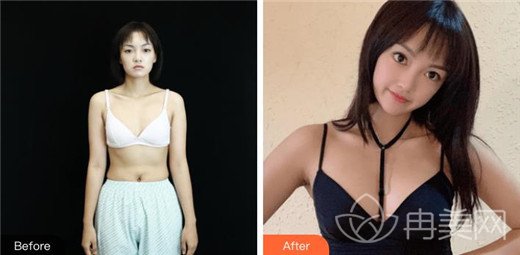 万连壮医生隆胸案例