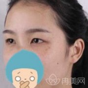 湘雅附一院整形科割双眼皮才30天，太自然像没做过一样