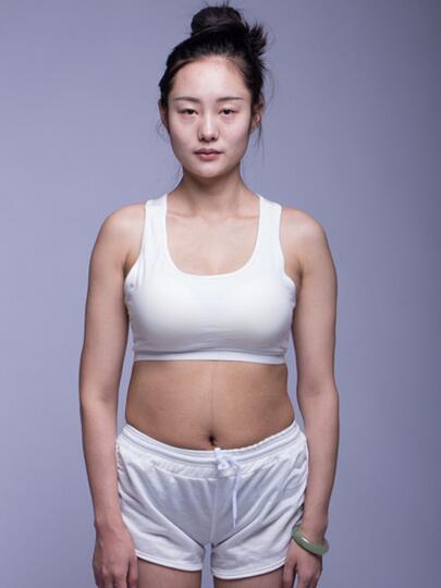 腰腹吸脂全身塑形案例，身轻如燕美出天际~