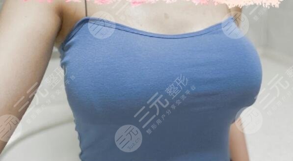 千万别做假体隆胸!给各位爱美姐妹们的忠告!