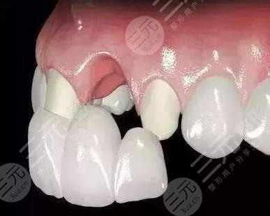 烤瓷牙可以用多少年?烤瓷牙应该怎么护理?烤瓷牙真实案例