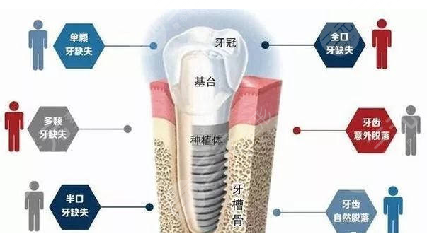 国产种植牙多少钱