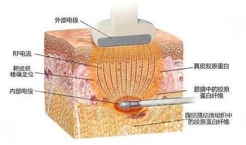 腰部塑形提高代谢做超脂塑溶脂