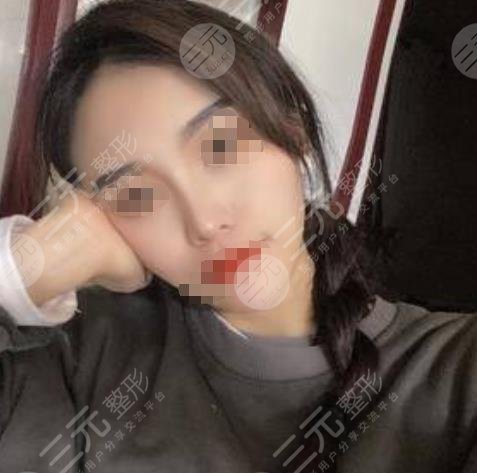 衡水整形医院隆鼻案例