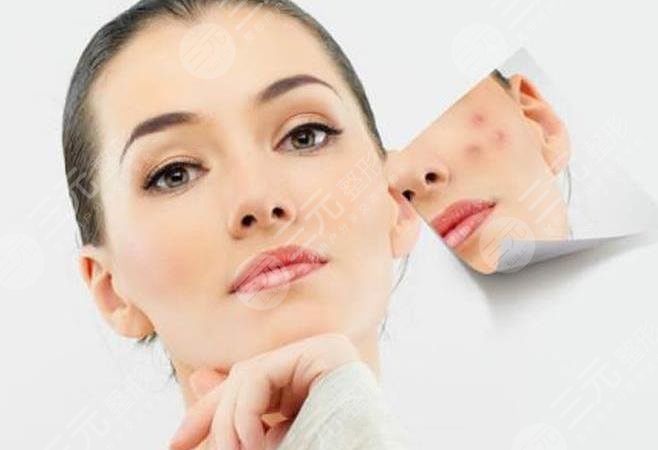 光子嫩肤祛痘印怎么样?效果明显吗?要做几次?内附价格表