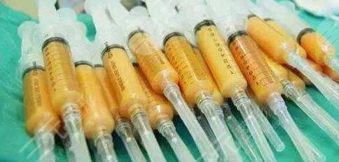 脂肪填充全脸手术的效果