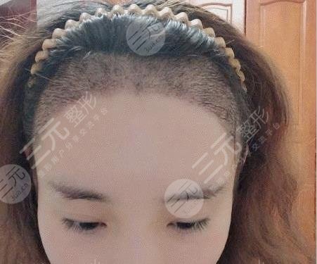 成都恒博医院发际线种植案例分享