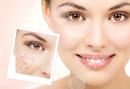 北京空军总医院激光整形中心于德印医生激光祛痘原理科普