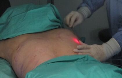 钻石精雕瘦手臂后背效果图