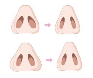 鼻孔缩小术 鼻孔缩小术