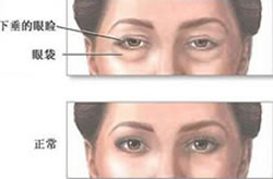 无痕去眼袋 无痕去眼袋