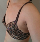 脂肪移植隆胸让我丰满感UP!自信感UP!