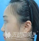 成都天使之翼金辉主任隆鼻案例:韩式生科硅胶假体隆鼻