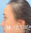 成都天使之翼金辉主任隆鼻案例:韩式生科硅胶假体隆鼻