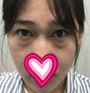 遵义韩美去眼袋技术怎么样?亲身体验后晒出术前术后照