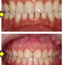 一口牙改变一张脸 她在重庆华美亲身实践牙齿矫正来证明