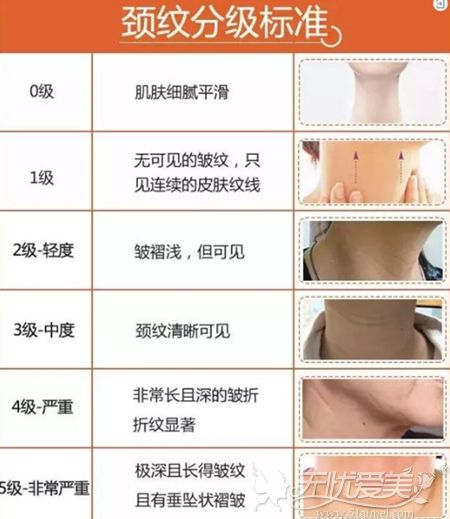 连续注射嗨体去颈纹3次不知道能维持多长时间？