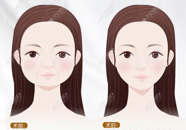 下颌角磨骨前后对比照片 下颌角磨骨前后对比照片