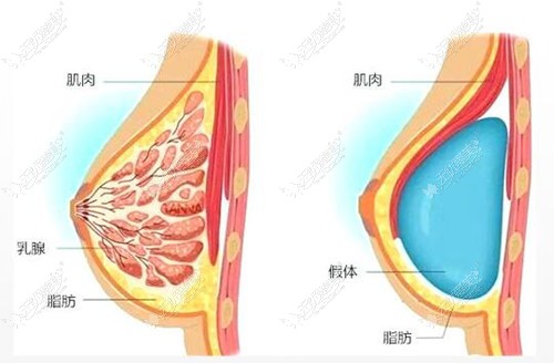 林沸腾做假体隆胸不硬,技术好 林沸腾做假体隆胸不硬,技术好