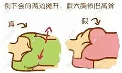 沸腾沟丰胸术靠谱,不显假 沸腾沟丰胸术靠谱,不显假