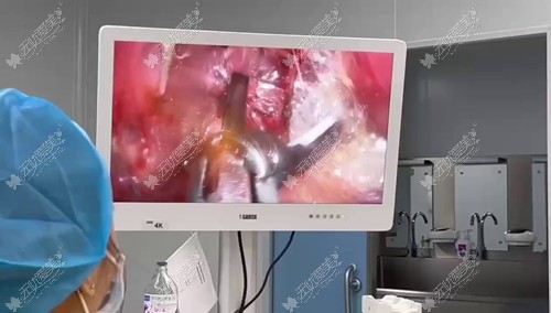 厦门欧菲内窥镜丰胸技术51aimei.com 厦门欧菲内窥镜丰胸技术51aimei.com