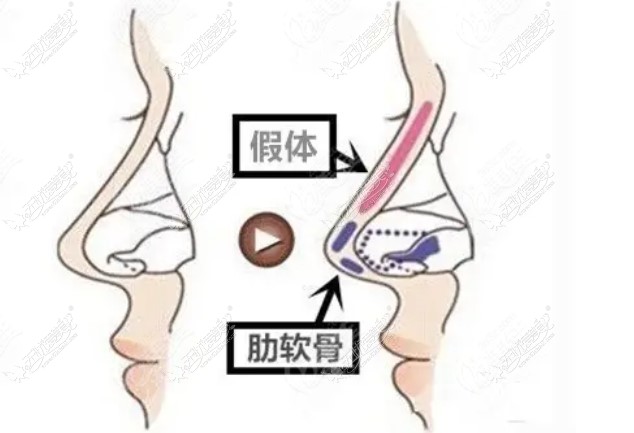 李信锋鼻修复技术优势 baike.51aimei.com 李信锋鼻修复技术优势 baike.51aimei.com
