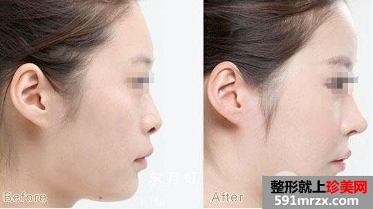 ��������¡����ʲô�ŵ㣬Ч����ô��