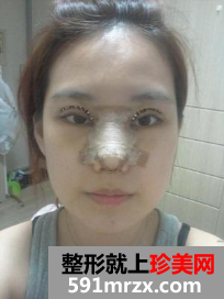 隆鼻割双眼皮多久恢复 郑州梨花雨整形美容医院割双眼皮+硅胶隆鼻归来 隆鼻割双眼皮多久恢复 郑州梨花雨整形美容医院割双眼皮+硅胶隆鼻归来