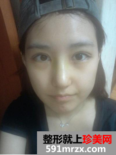 隆鼻割双眼皮多久恢复 郑州梨花雨整形美容医院割双眼皮+硅胶隆鼻归来 隆鼻割双眼皮多久恢复 郑州梨花雨整形美容医院割双眼皮+硅胶隆鼻归来