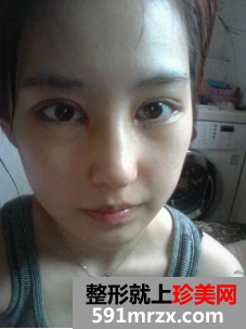 隆鼻割双眼皮多久恢复 郑州梨花雨整形美容医院割双眼皮+硅胶隆鼻归来 隆鼻割双眼皮多久恢复 郑州梨花雨整形美容医院割双眼皮+硅胶隆鼻归来