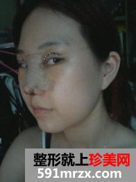 隆鼻割双眼皮多久恢复 郑州梨花雨整形美容医院割双眼皮+硅胶隆鼻归来 隆鼻割双眼皮多久恢复 郑州梨花雨整形美容医院割双眼皮+硅胶隆鼻归来