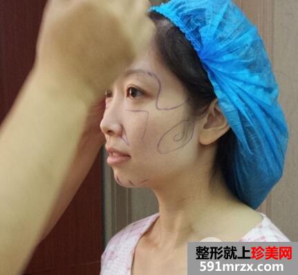 ����֬��������Ǯ������֬��������׻ָ�������ʵ����